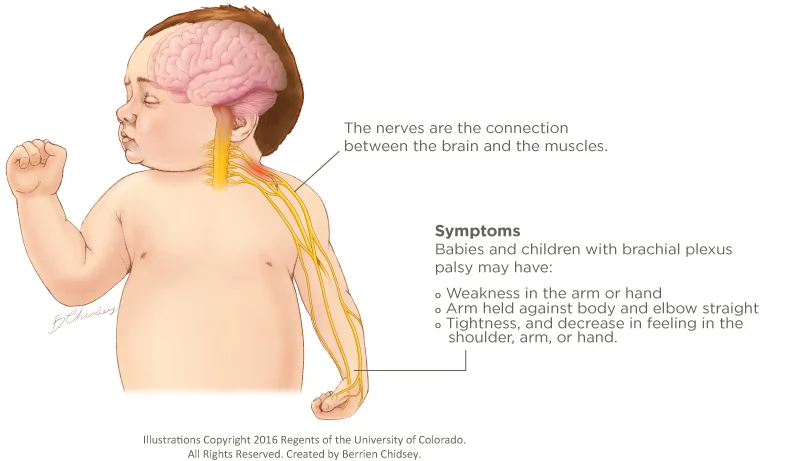 Detailed visual of Brachial Plexus Injuries, highlighting affected nerves and possible injury types