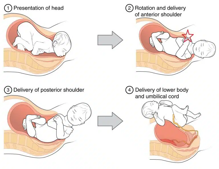 Visual guide displaying various maneuvers for addressing shoulder dystocia in labor