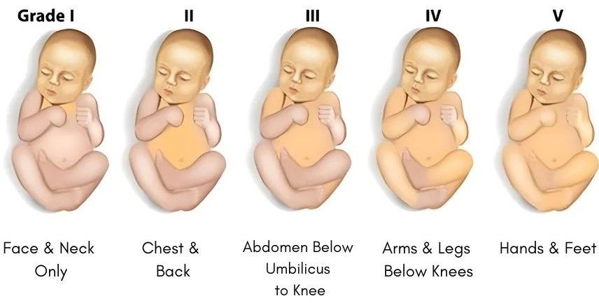 Stages of Neonatal Jaundice