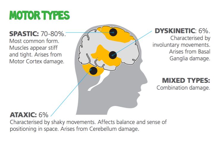 Mixed Cerebral Palsy Birth Injury